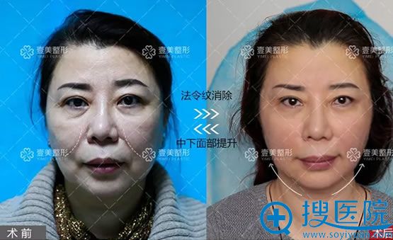 �Ͳ�Ҽ���沿������������Ч��ͼ