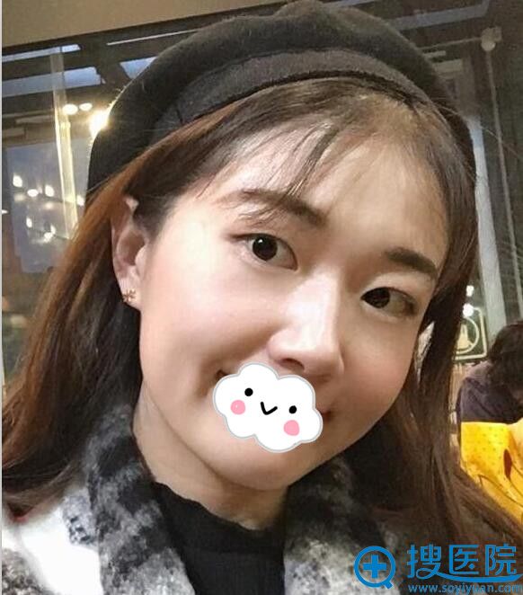 四川汉密尔顿双眼皮术前 四川汉密尔顿双眼皮术前