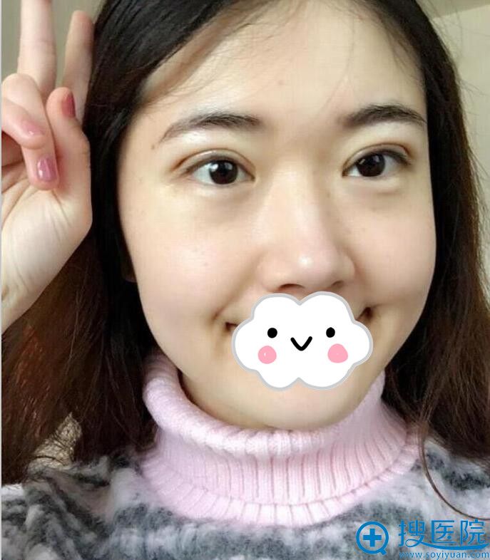 <!--<i data=20240710 data-id=8487></i>-->双眼皮术后10天效果 <!--<i data=20240710 data-id=8487></i>-->双眼皮术后10天效果