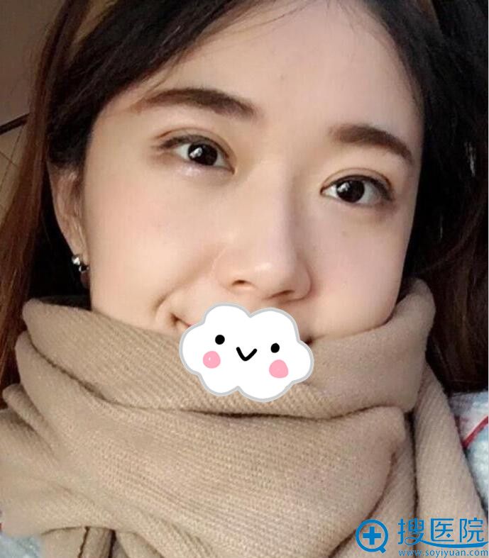 在四川汉密尔顿美容医院做双眼皮术后20天 在四川汉密尔顿美容医院做双眼皮术后20天