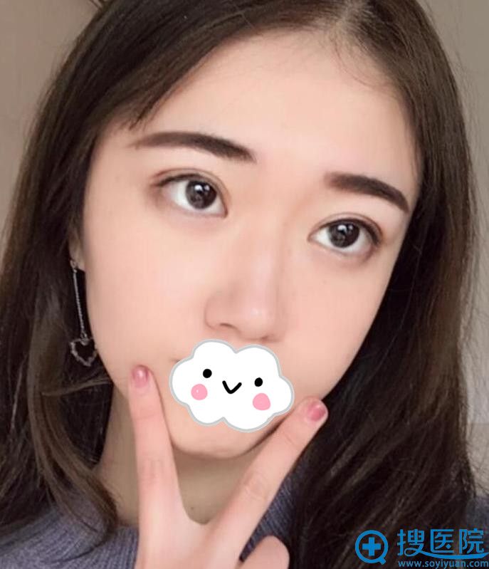 在<!--<i data=20240710 data-id=8487></i>-->双眼皮术后35天 在<!--<i data=20240710 data-id=8487></i>-->双眼皮术后35天