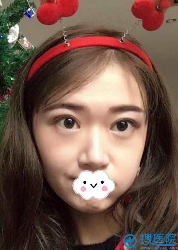 四川汉密尔顿美容医院双眼皮案例 四川汉密尔顿美容医院双眼皮案例