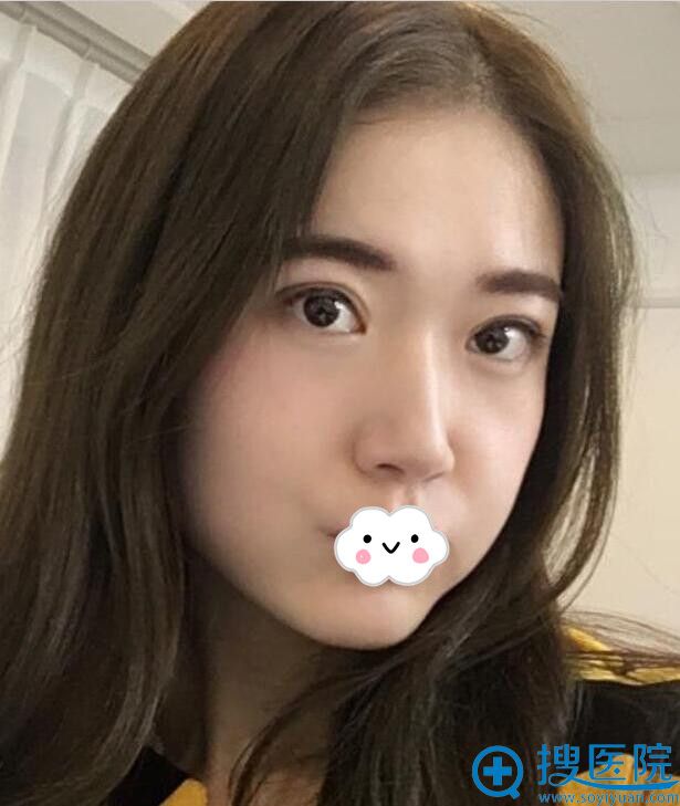 四川汉密尔顿美容医院双眼皮术后110天 四川汉密尔顿美容医院双眼皮术后110天