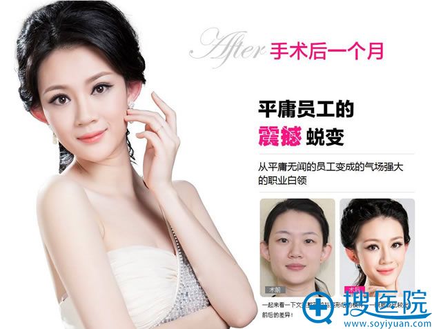 淄博壹美整形医院员工做双眼皮案例效果 淄博壹美整形医院员工做双眼皮案例效果