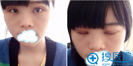 王俊切开双眼皮术后睁眼闭眼效果 王俊切开双眼皮术后睁眼闭眼效果