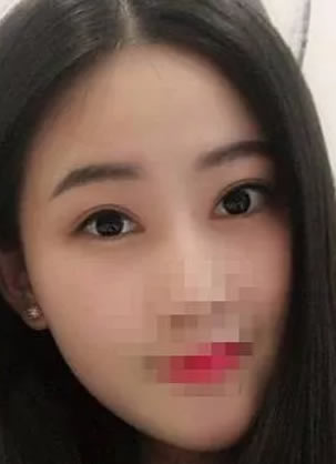 来评价一下我在蚌埠美莱坞做开内眼角和割双眼皮3个月效果如何