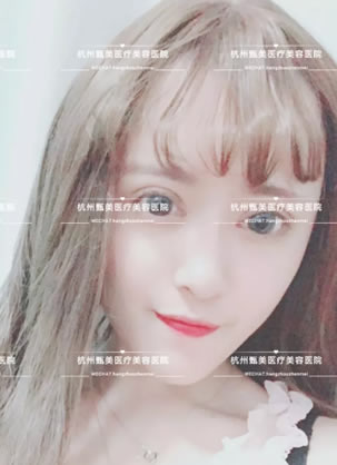 杭州甄美整形医院黄庆武医生假体下巴和自体脂肪填充全脸案例