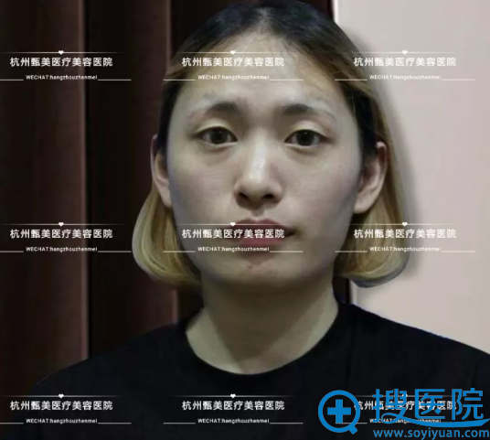王小姐做下巴和自体脂肪填充前 王小姐做下巴和自体脂肪填充前