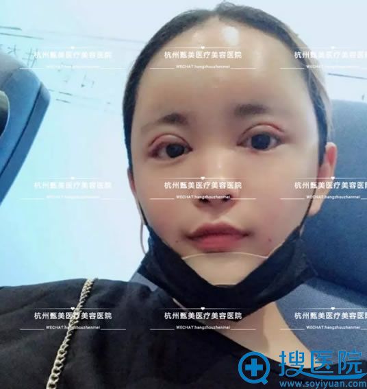 杭州甄美假体丰下巴手术即刻效果 杭州甄美假体丰下巴手术即刻效果