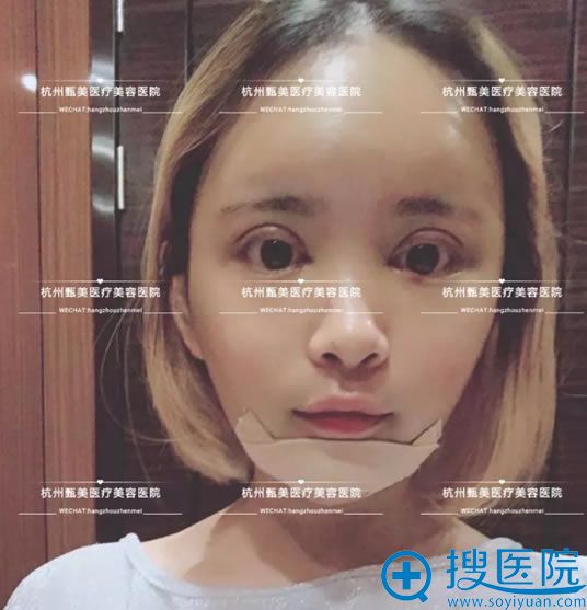 选择杭州甄美做假体垫下巴和双眼皮手术第3天 选择杭州甄美做假体垫下巴和双眼皮手术第3天