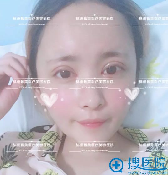 杭州甄美黄庆武自体脂肪填充案例第7天效果 杭州甄美黄庆武自体脂肪填充案例第7天效果
