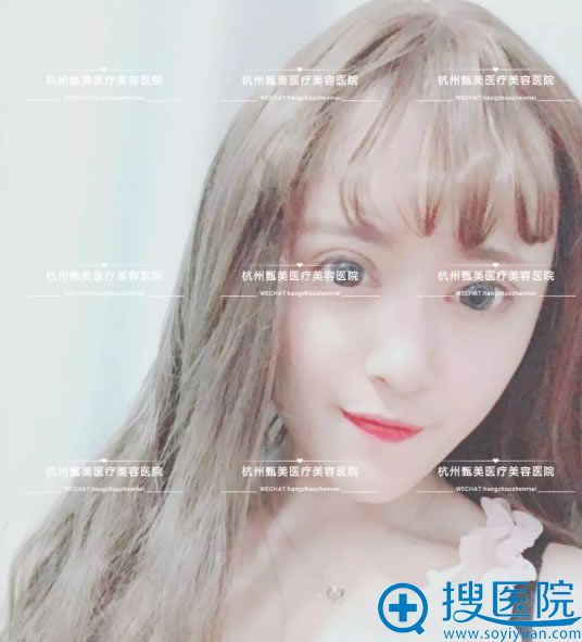 杭州甄美假体垫下巴真人案例30天效果 杭州甄美假体垫下巴真人案例30天效果