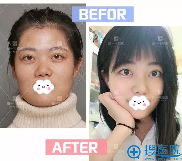 西安高一生综合隆鼻前后对比 西安高一生综合隆鼻前后对比