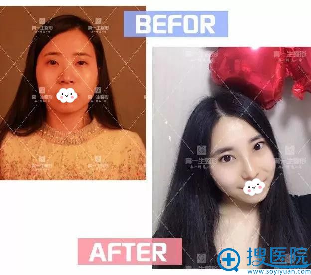 西安高一生隆鼻案例对比 西安高一生隆鼻案例对比