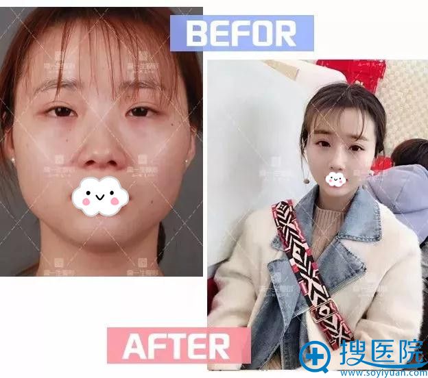 她在西安高一生隆鼻后变360女神 她在西安高一生隆鼻后变360女神