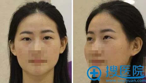 在蚌埠美莱坞做开眼角和双眼皮手术前 在蚌埠美莱坞做开眼角和双眼皮手术前
