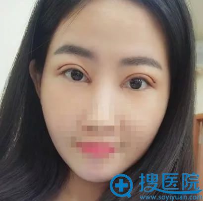 在蚌埠美莱坞做开内眼角和割双眼皮第3天 在蚌埠美莱坞做开内眼角和割双眼皮第3天