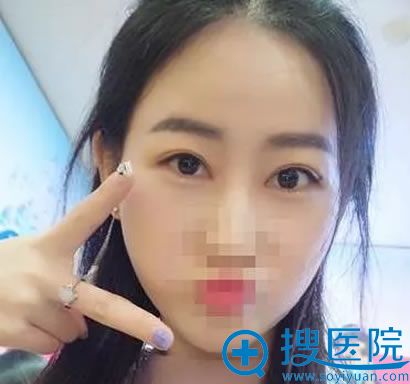 开眼角手术后第30天恢复效果图 开眼角手术后第30天恢复效果图