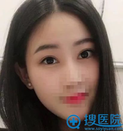 蚌埠美莱坞开眼角割双眼皮第3个月效果 蚌埠美莱坞开眼角割双眼皮第3个月效果