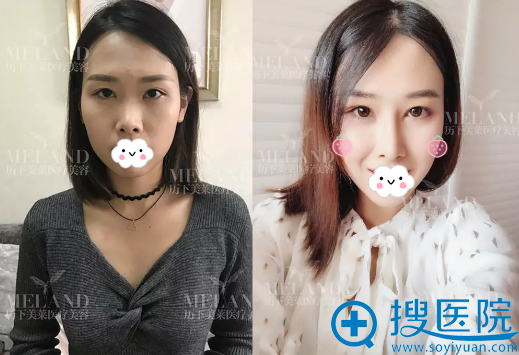 <!--<i data=20240710 data-id=14184></i>-->韩旭小翘鼻术后9天对比 <!--<i data=20240710 data-id=14184></i>-->韩旭小翘鼻术后9天对比