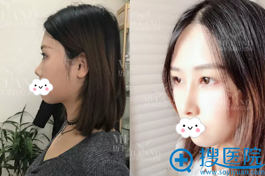 济南历下美莱肋软骨隆鼻对比照 济南历下美莱肋软骨隆鼻对比照
