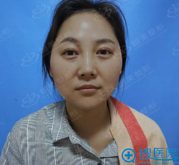 合肥哪家医院做线雕整形好?她在恒美做完面部提升后变18岁美貌