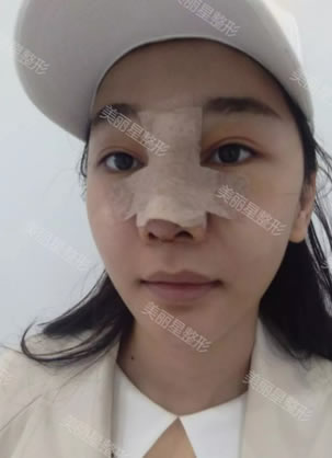 鉴定一下我选择南宁美丽星整形医院做立秀膨体隆鼻半年效果如何