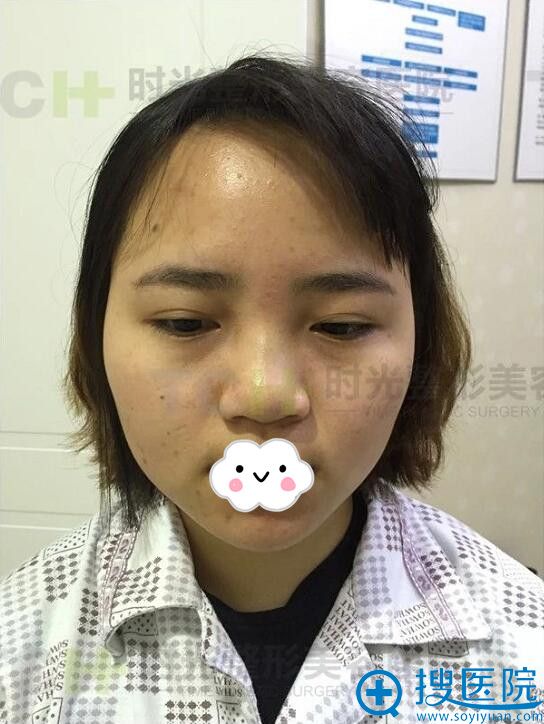 重庆时光假体隆鼻怎么样?妹纸开心分享术后2个月蜕变过程