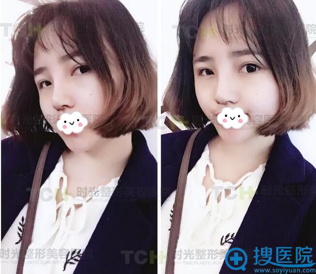 到重庆时光综合隆鼻术后7天 到重庆时光综合隆鼻术后7天
