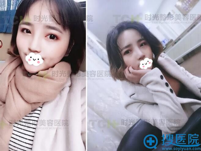 重庆时光鼻综合术后15天效果 重庆时光鼻综合术后15天效果