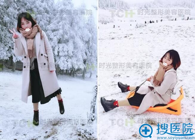 重庆时光陈院长做的鼻综合术后半月 重庆时光陈院长做的鼻综合术后半月
