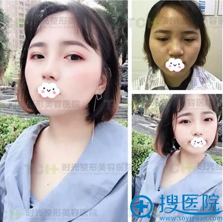到重庆时光做的鼻综合术后2个月效果 到重庆时光做的鼻综合术后2个月效果