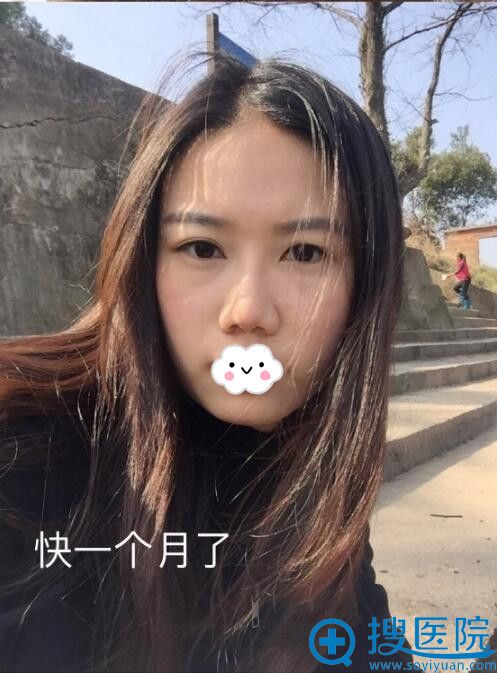 <!--<i data=20240710 data-id=12364></i>-->隆鼻术后25天案例 <!--<i data=20240710 data-id=12364></i>-->隆鼻术后25天案例
