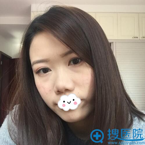 选择无锡美联臣做的假体+耳软骨隆鼻3个月后五官变的立体秀气