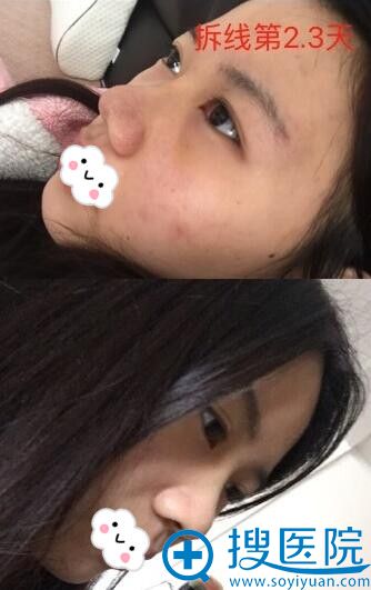 <!--<i data=20240710 data-id=12364></i>-->假体隆鼻术后2天效果 <!--<i data=20240710 data-id=12364></i>-->假体隆鼻术后2天效果