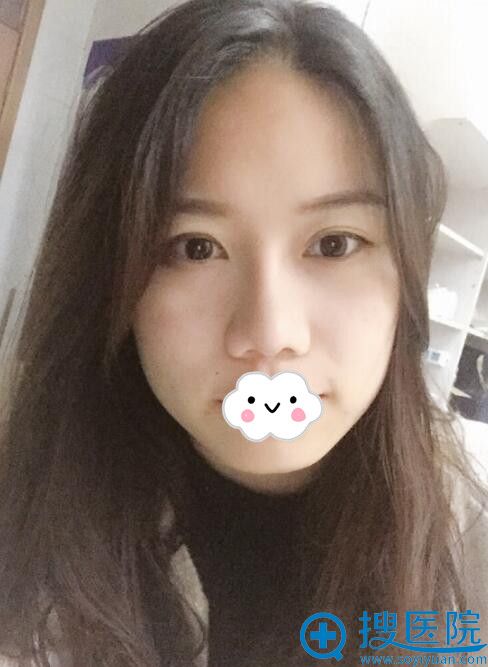 美联臣为我做假体隆鼻术后3个月 美联臣为我做假体隆鼻术后3个月