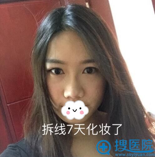 美联臣假体隆鼻术后15天效果 美联臣假体隆鼻术后15天效果