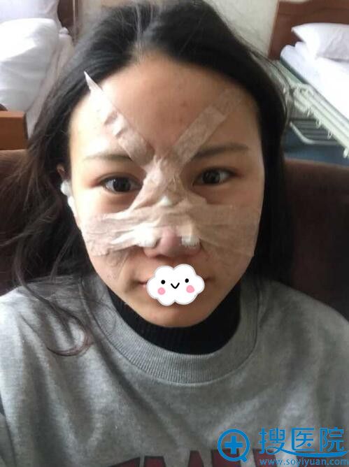 到<!--<i data=20240710 data-id=12364></i>-->假体隆鼻术后当天 到<!--<i data=20240710 data-id=12364></i>-->假体隆鼻术后当天