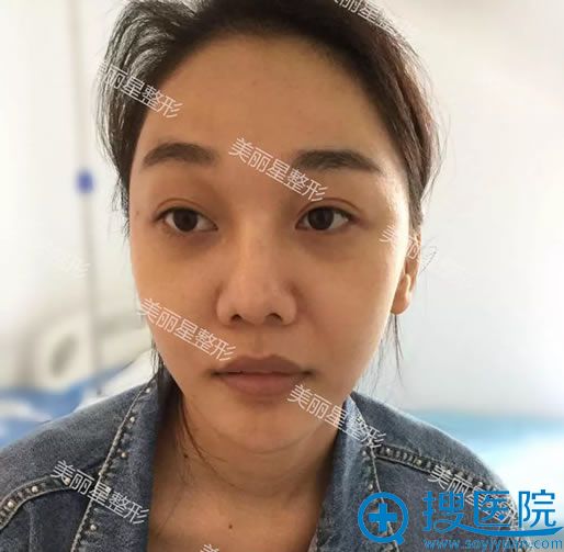 做膨体隆鼻手术前的塌鼻子照片 做膨体隆鼻手术前的塌鼻子照片