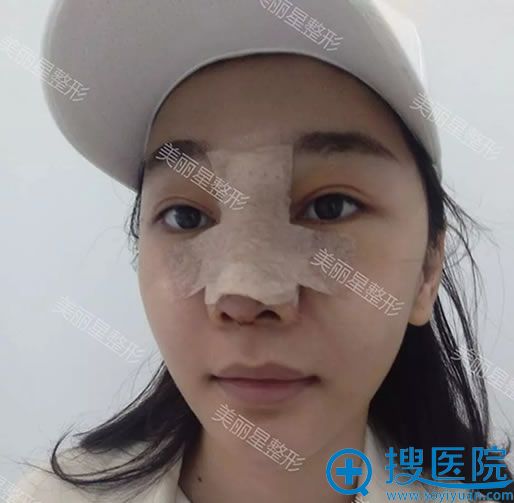 南宁美丽星膨体隆鼻手术当天效果 南宁美丽星膨体隆鼻手术当天效果