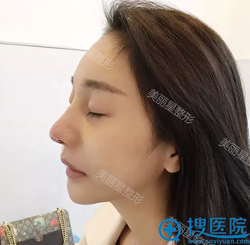 做膨体隆鼻手术第7天拆线效果 做膨体隆鼻手术第7天拆线效果