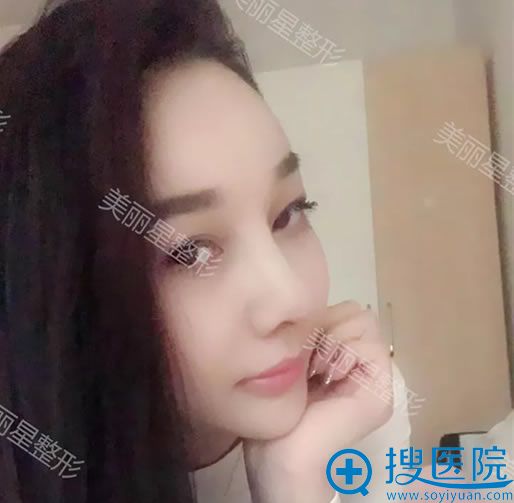 在美丽星做完隆鼻手术15天带妆照 在美丽星做完隆鼻手术15天带妆照