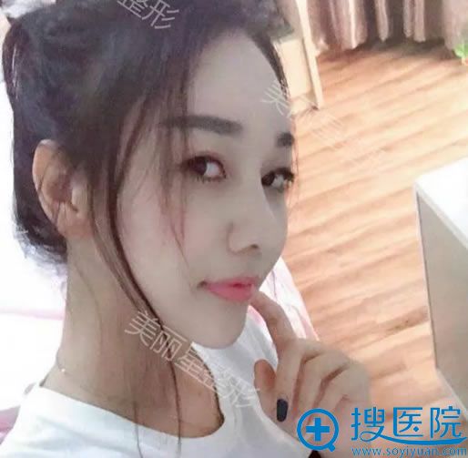 南宁美丽星李武斌隆鼻案例3个月效果 南宁美丽星李武斌隆鼻案例3个月效果