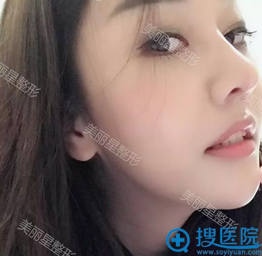 南宁美丽星鼻综合案例5个月效果 南宁美丽星鼻综合案例5个月效果