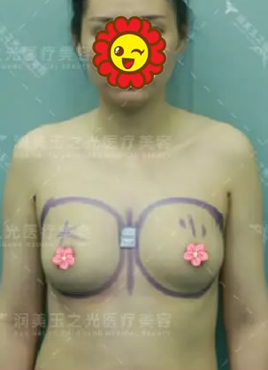 宝妈用CGF活性脂肪丰胸真实经历告诉你自体脂肪隆胸玉之光靠谱