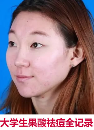 青岛祛痘的医院哪家好 学生妹子在壹美的果酸祛痘效果供你参考