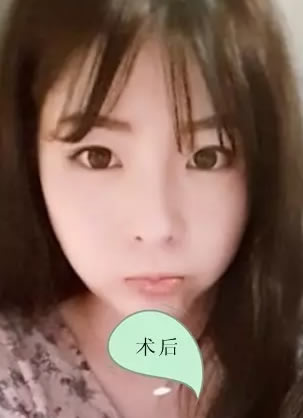 回顾找济宁口碑不错的韩美整形医院做鼻综合和双眼皮逆垄过程
