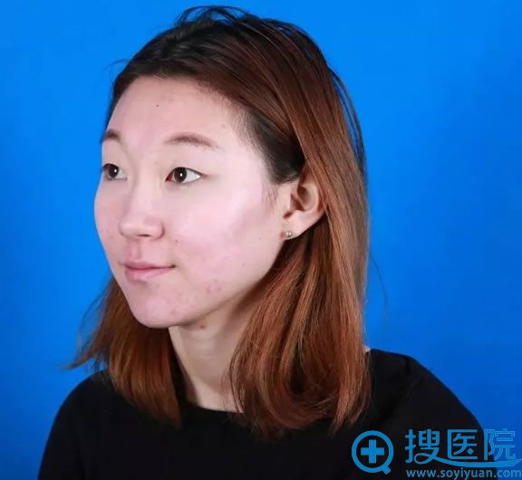 吴学生在壹美做果酸祛痘前照片 吴学生在壹美做果酸祛痘前照片