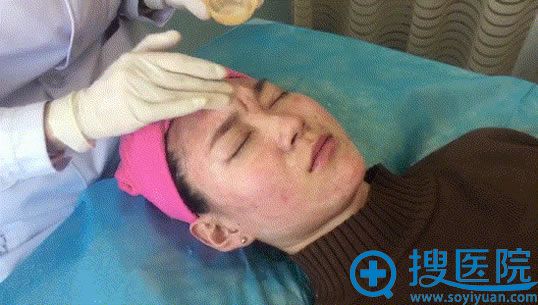 青岛壹美果酸祛痘手术过程 青岛壹美果酸祛痘手术过程