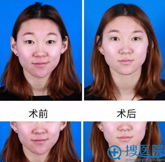 青岛壹美果酸祛痘案例前后效果对比图 青岛壹美果酸祛痘案例前后效果对比图